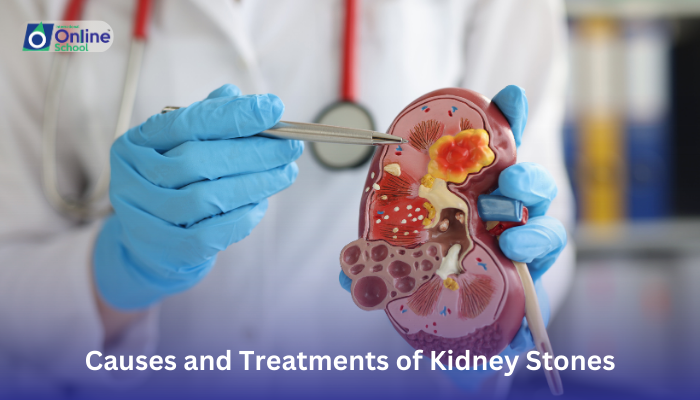 Lesson 17: Causes and Treatments of Kidney Stones
